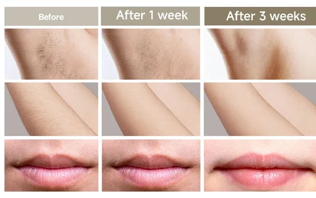 4-in-1 Laser Epilator Laser Hot Sell Permanent IPL Photoepilator Hair Removal Painless Electric Epilator Machine